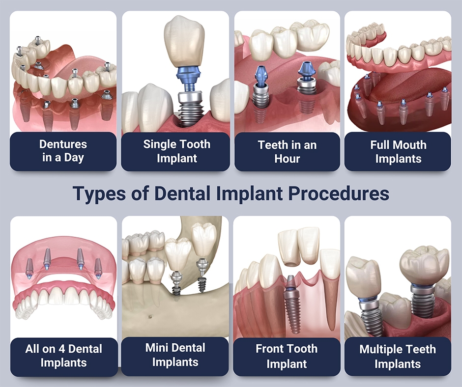 types-of-dental-implant-procedures