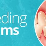 What Causes Gums to Bleed