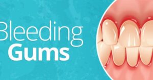 bleeding gums treatment