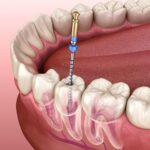 Unlocking the Mystery of a Root Canal